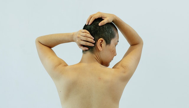 acne nas costas
